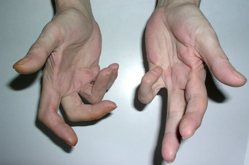 maladie de dupuytren main sévère bilatéral