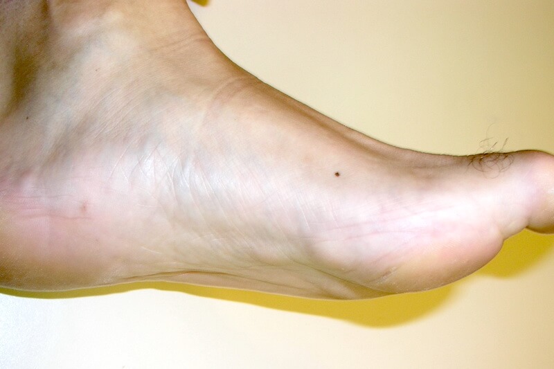 maladie de dupuytren pied - nodule sous le pied - photo maladie de ledderhose