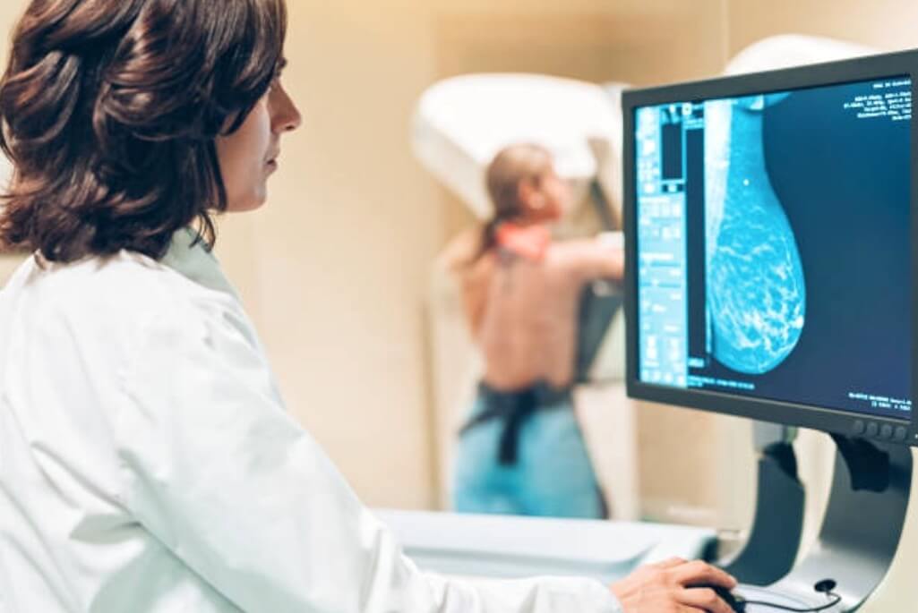 Mammographie - maladie de dupuytren et cancer du sein