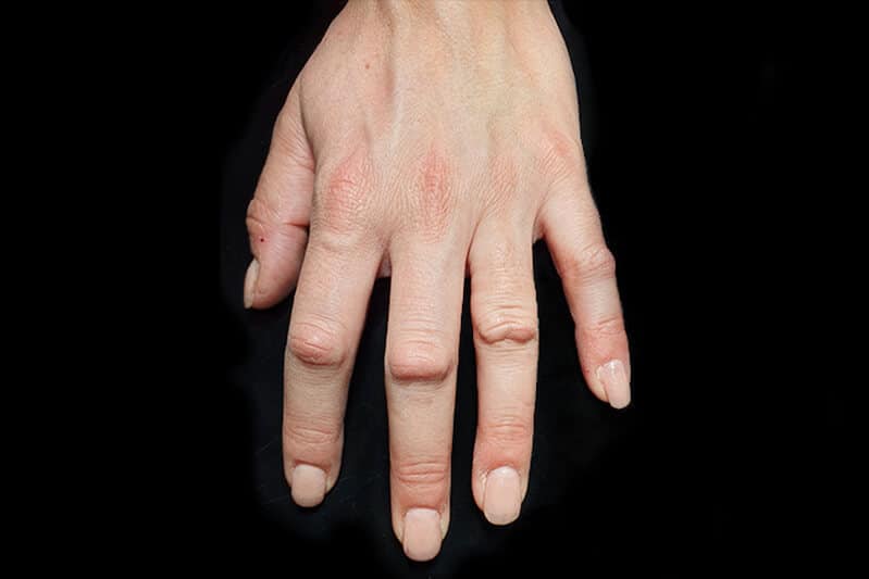 maladie dupuytren premiers symptomes - Coussinets phalangiens dos des doigts