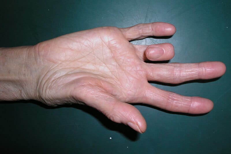maladie de dupuytren temps d'évolution - doigt qui se rétracte en crochet