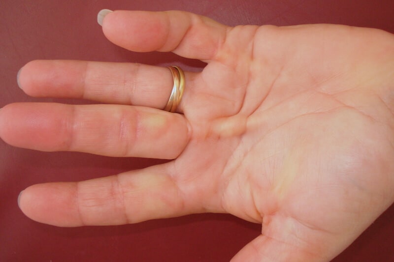 nodule et corde de dupuytren symptomes - maladie de la main