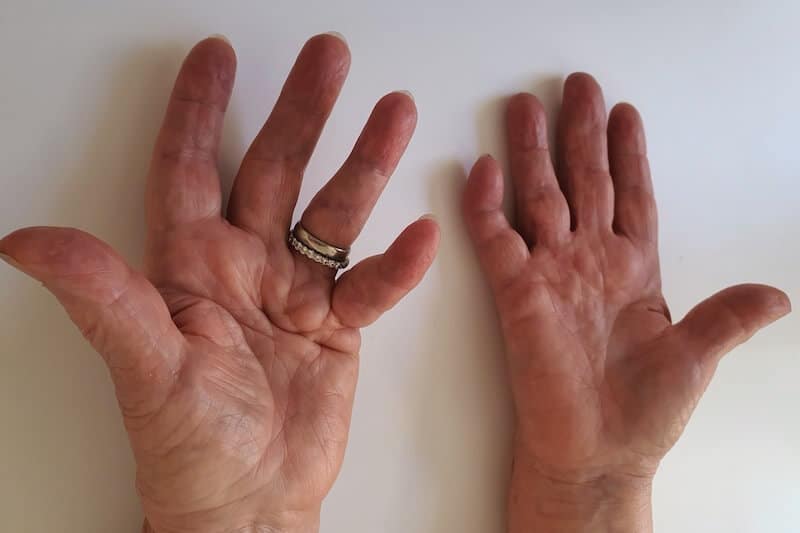 stades maladie dupuytren main douleur bilatérale