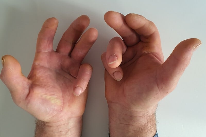 maladie de dupuytren debut symptomes main - cause traumatisme de la main