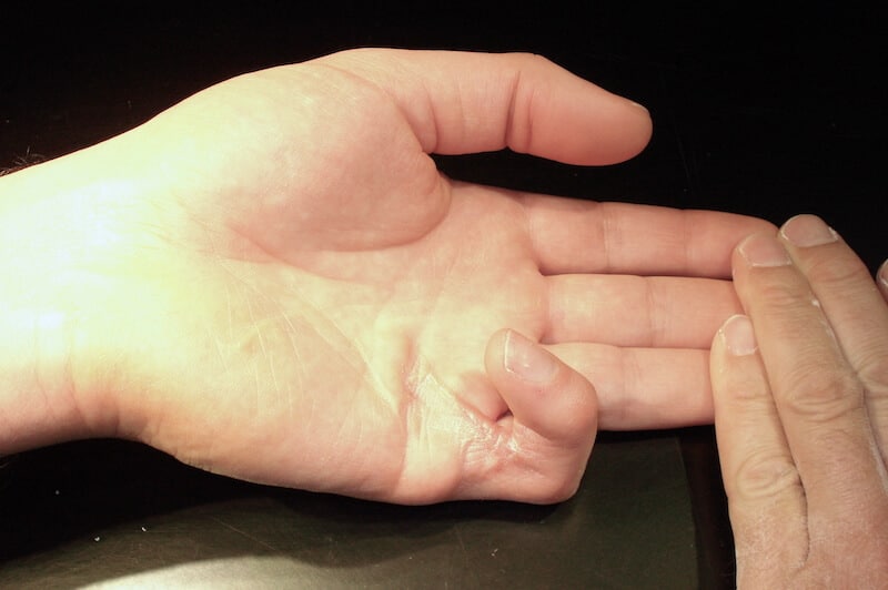 stades maladie de dupuytren évolution symptomes - corde dupuytren 5e doigt en crochet