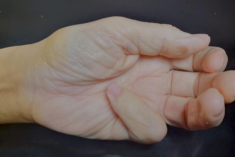 maladie-de-dupuytren-main-fibromatose-de-l-apon-vrose-palmaire-pr