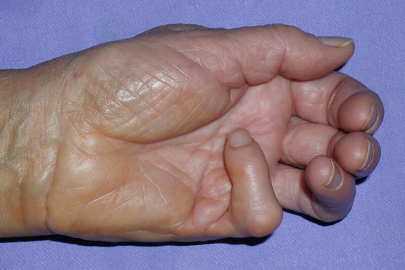stades maladie de dupuytren - déformation des doigts