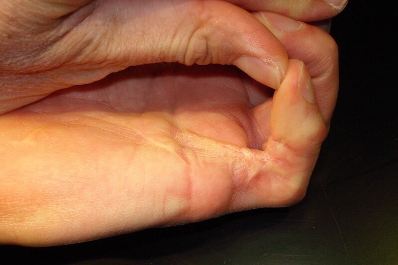 Complication maladie de Dupuytren - risque raideur doigt
