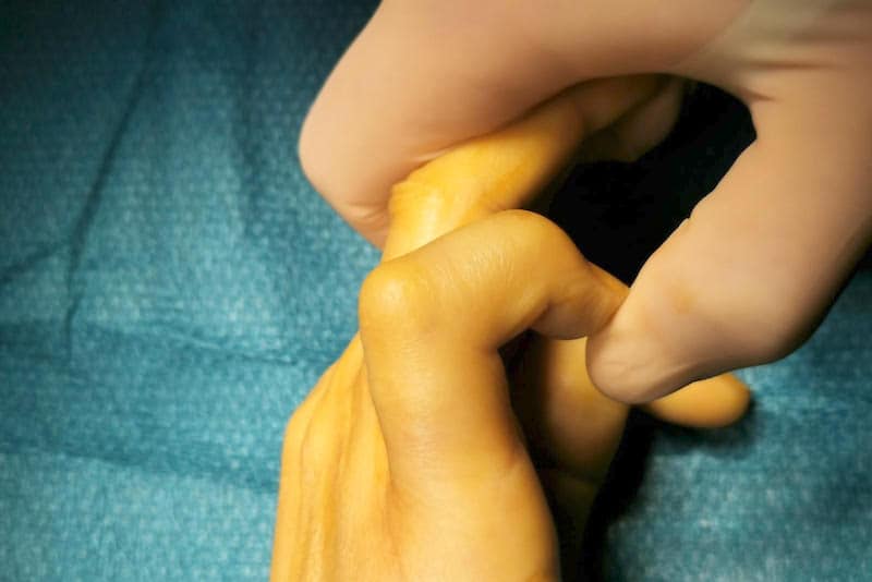 rétraction des doigts - maladie de dupuytren traitement kiné inefficace