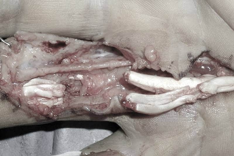 Section tendon des fléchisseurs après aponévrotomie à l'aiguille - Dupuytren risque de complication