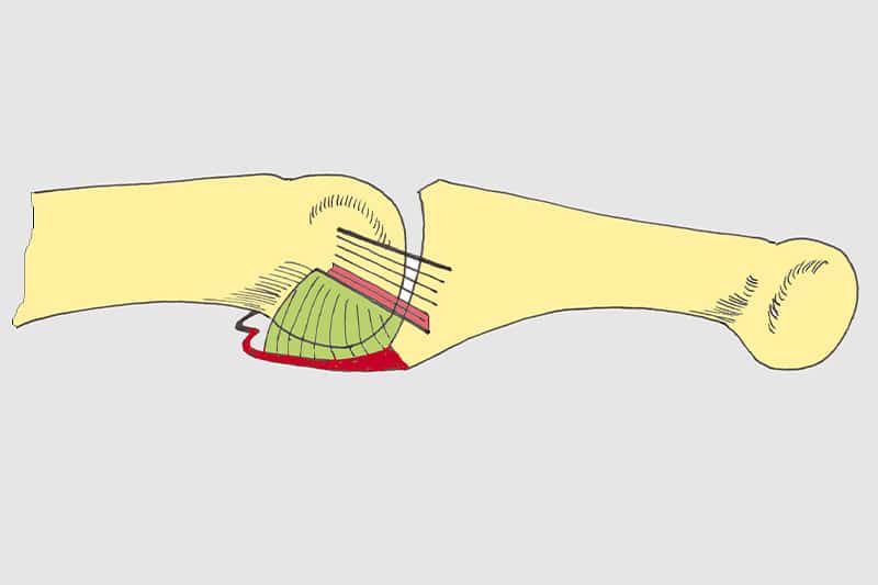 arthrolyse doigt tendons extensseurs - chirurgie dupuytren
