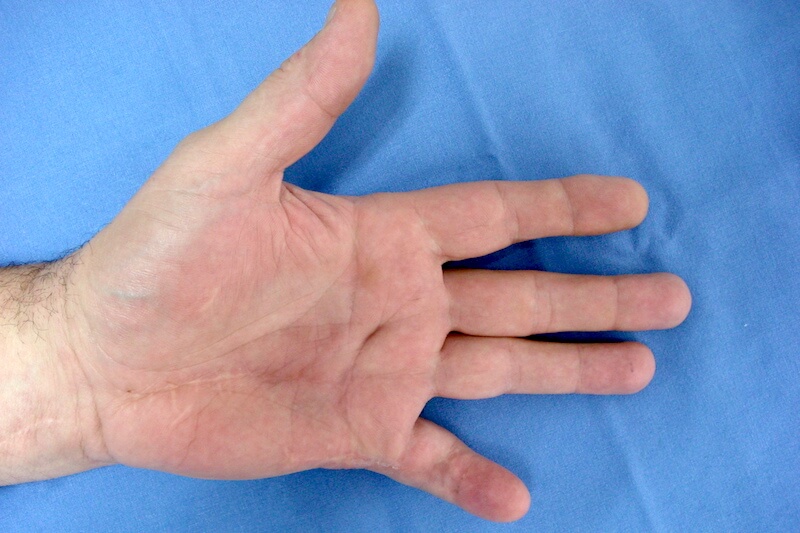 arthrodèse de doigt de la main
