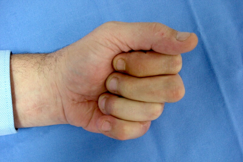 arthrodèse doigt ipp après opération