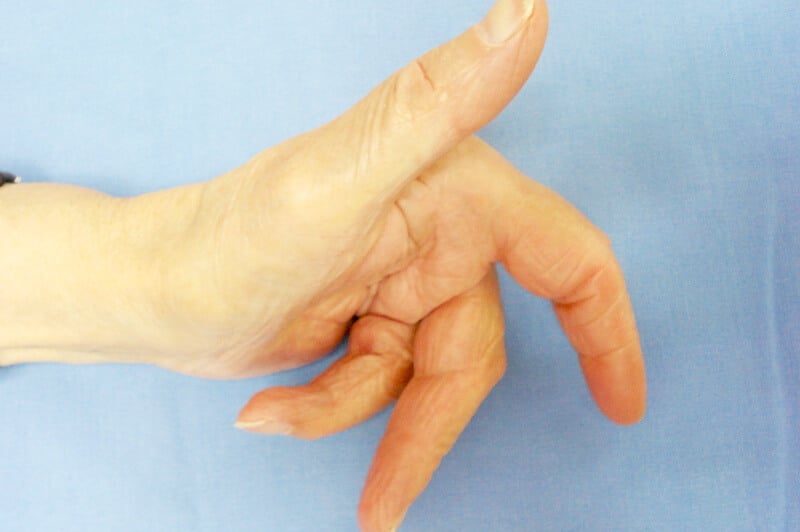 maladie dupuytren amputation doigt main gauche