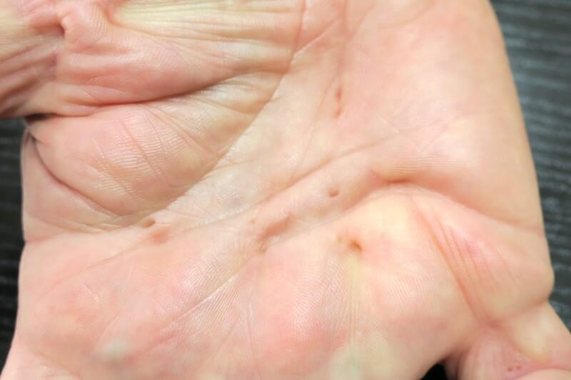 Nombreuses ombilications sous forme de trous dans la paume de la main